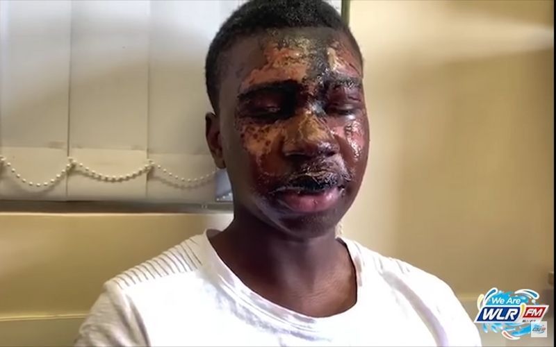 Irish teen recovers from brutal acid attack to win US college scholarship