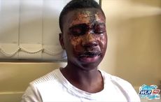 Irish teen recovers from brutal acid attack to win US college scholarship