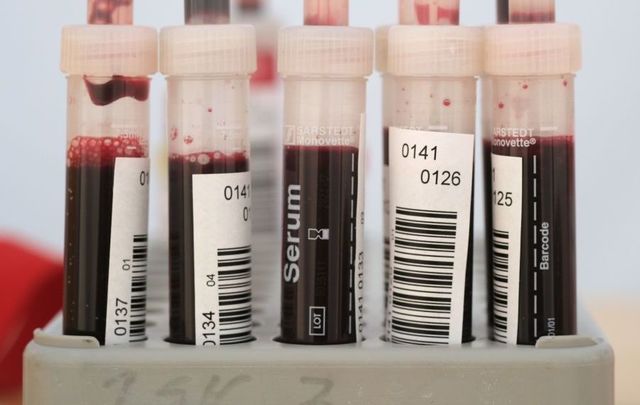 COVID-19: The FDA announced it was altering restrictions on blood donations by gay and bisexual men. 