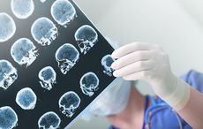 Irish trial shows promise for Alzheimer’s patients