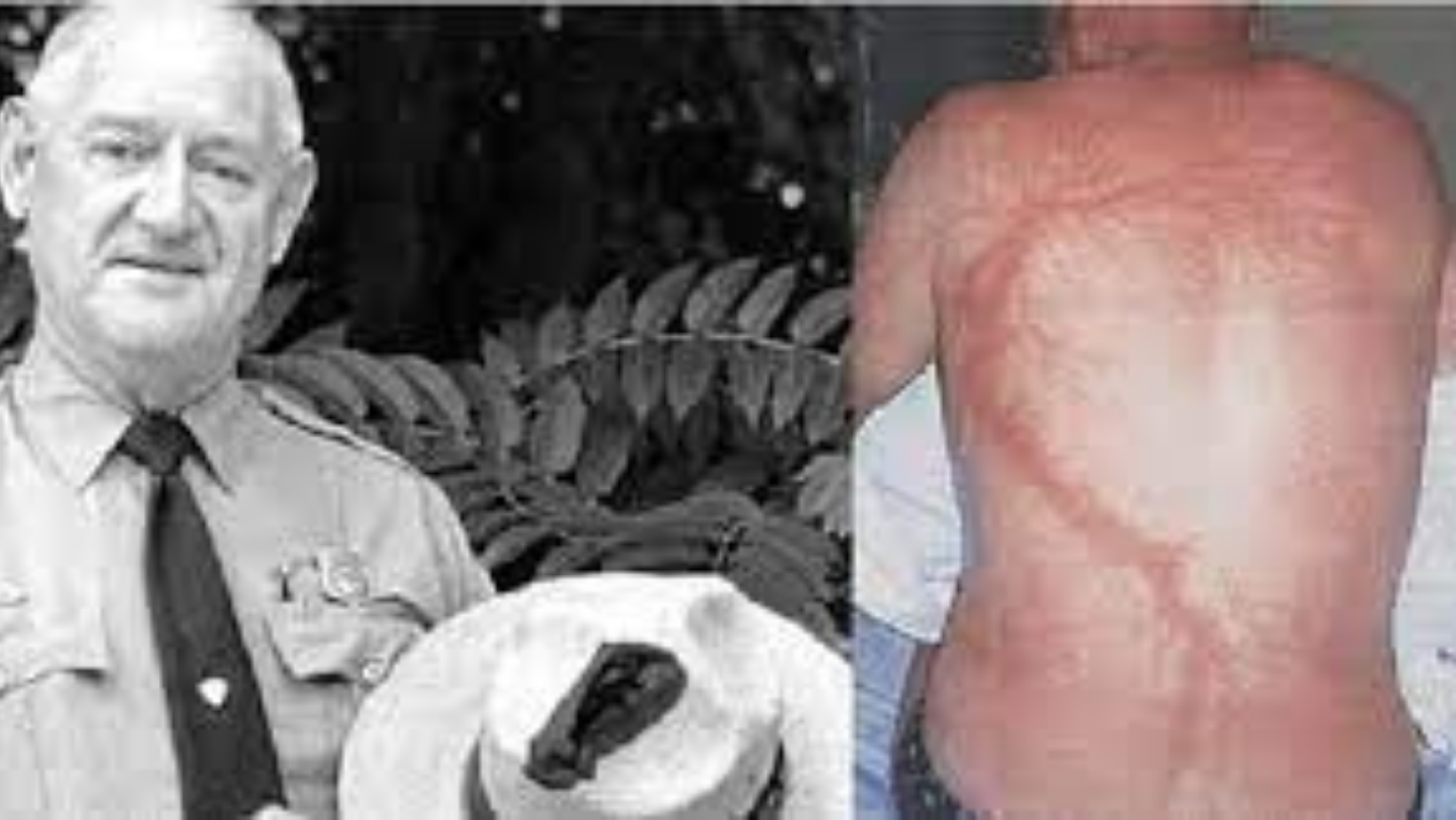 Roy Sullivan: Struck by lightning seven times