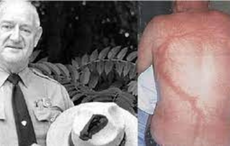 Roy Sullivan: Struck by lightning seven times