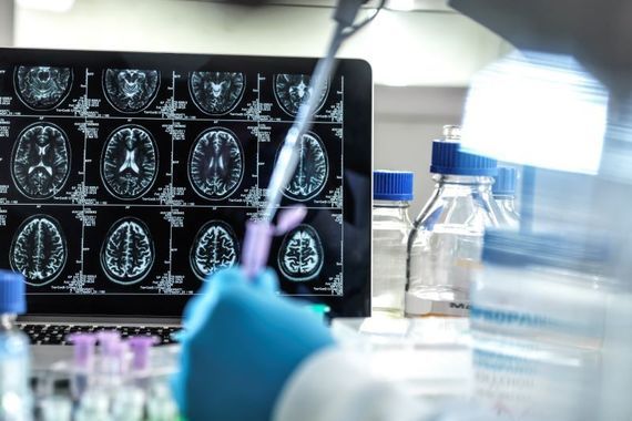 Galway scientists "transform stroke surgery" with new system for removing brain clots
