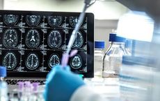 Galway scientists "transform stroke surgery" with new system for removing brain clots