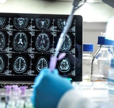 Galway scientists "transform stroke surgery" with new system for removing brain clots