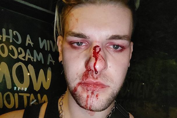 Mark Sheehan shared pictures of his injuries on social media after being attacked on a Dublin Bus route.
