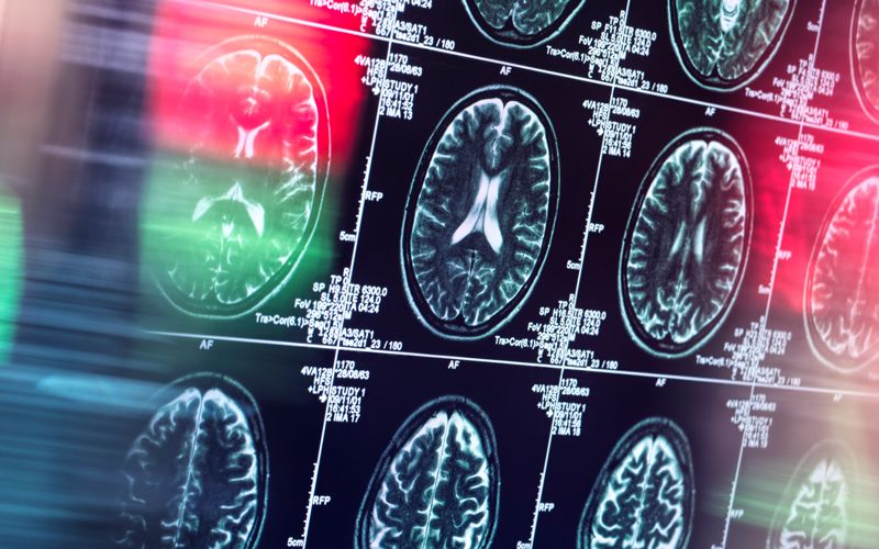 Rare cancer causes American man to develop "uncontrollable Irish brogue accent"