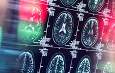 Rare cancer causes American man to develop "uncontrollable Irish brogue accent"