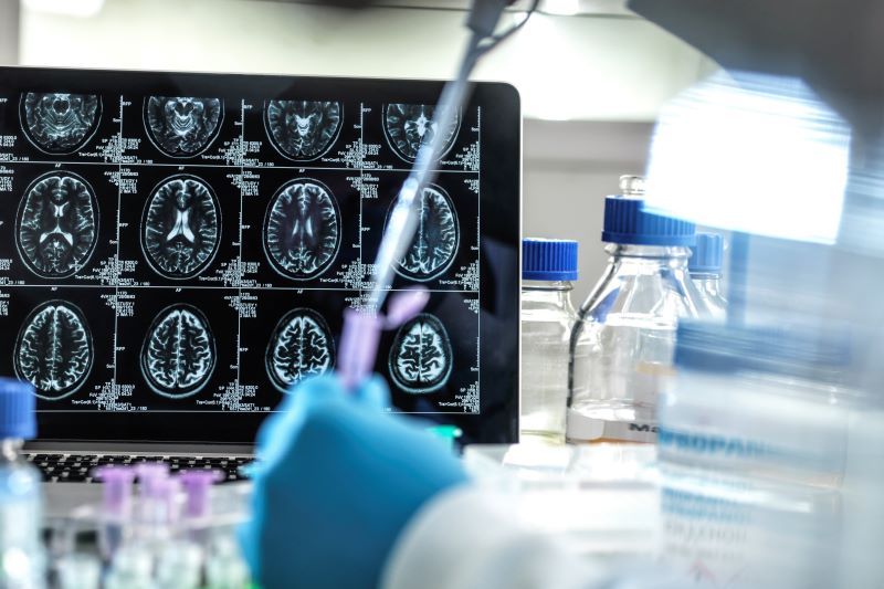 Irish scientists seek out "live" human brain samples for new research