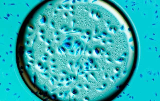 Scientists at Ulster University have developed a promising new treatment to fight prostate cancer.