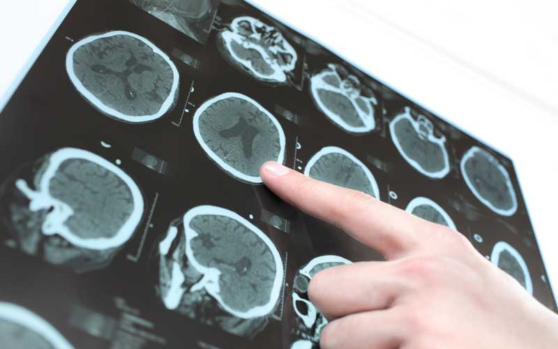 Galway scientists find collagen implant brain fix for Parkinson’s sufferers