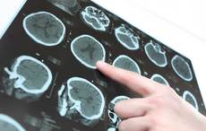 Galway scientists find collagen implant brain fix for Parkinson’s sufferers