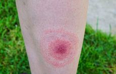 Living with Lyme Disease in Ireland – an upside-down world