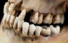 Famine victims had badly rotten teeth due to heavy smoking new study reveals