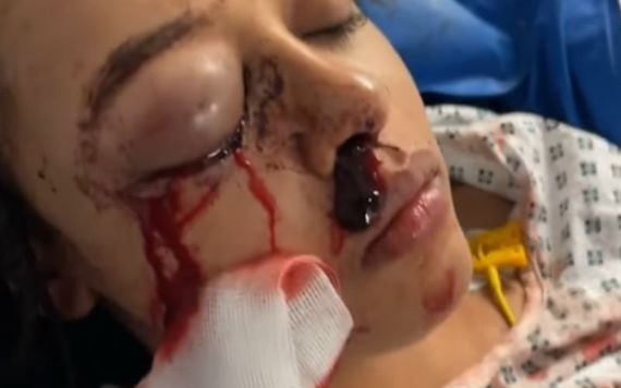 Alanna Quinn Idris was left with severe facial injuries. Credit: GoFundMe Alanna Quinn Idris was left with severe facial injuries. Credit: GoFundMe