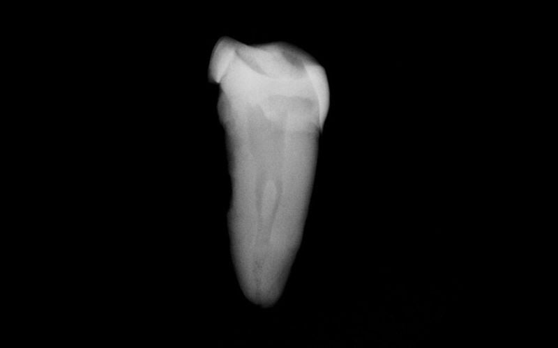 An X Ray of one of the teeth by forensic expert, Dr. Matt Patterson, showing that the teeth recovered were those of a laborer because of the wear on the tooth. An X Ray of one of the teeth by forensic expert, Dr. Matt Patterson, showing that the teeth recovered were those of a laborer because of the wear on the tooth.