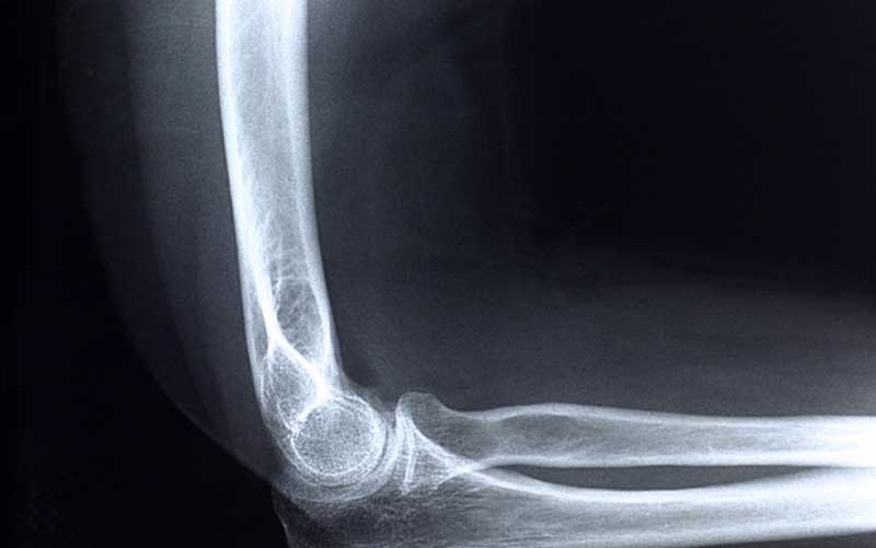 An X-ray of an elbow. Credit: Getty Images