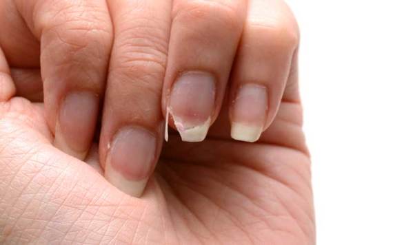 Broken fingernail. Credit: iStock