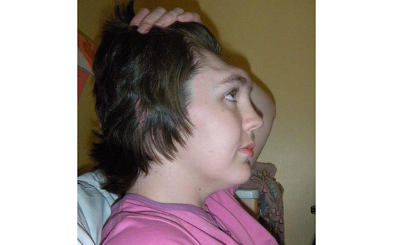Dramatic profile photo shows the extent of the damage to her skull.