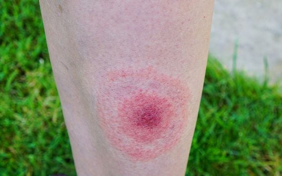 Tick bite. (Getty Images)
